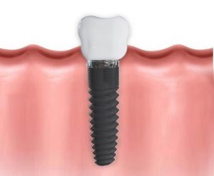 Cosmetic Dentistry in Fuquay Varina for Dental implants