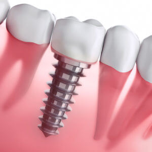 Mike Hamby DDS | Cosmetic Dentistry